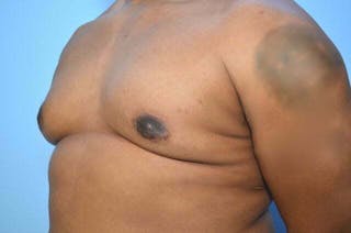 Male Breast Reduction Before & After Gallery - Patient 417583 - Image 8