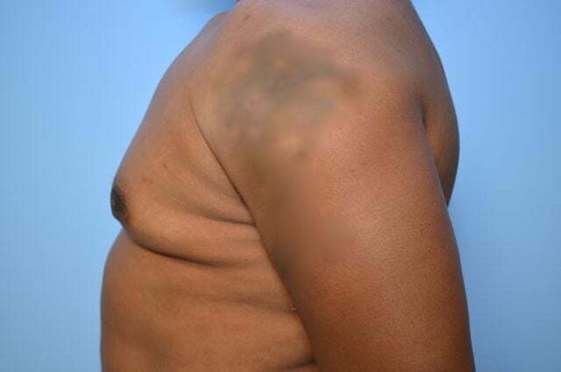 Male Procedures by Dr. Hess Before & After Gallery - Patient 417583 - Image 9