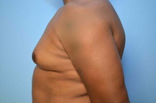 Male Breast Reduction Before & After Gallery - Patient 417583 - Image 10