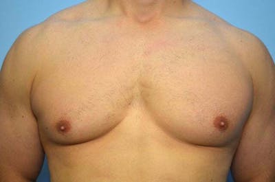 Male Procedures by Dr. Hess Before & After Gallery - Patient 147447 - Image 1