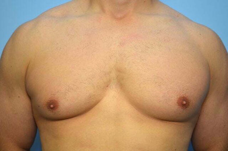 Male Procedures by Dr. Hess Before & After Gallery - Patient 147447 - Image 1