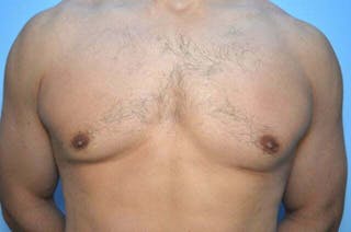 Male Breast Reduction Before & After Gallery - Patient 147447 - Image 2