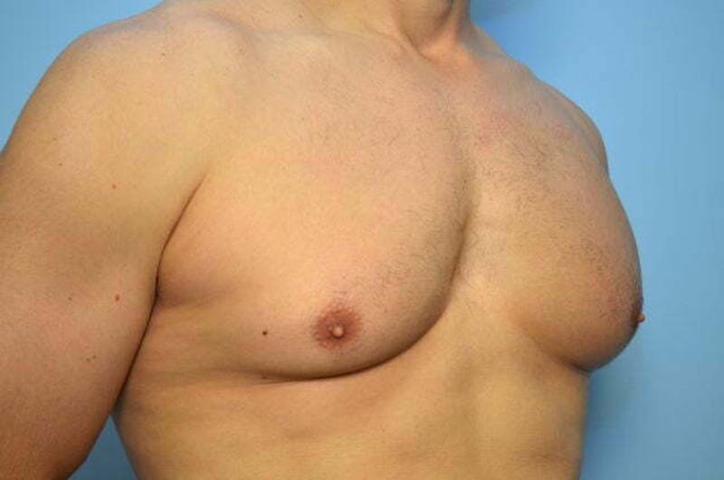 Male Procedures by Dr. Hess Before & After Gallery - Patient 147447 - Image 3