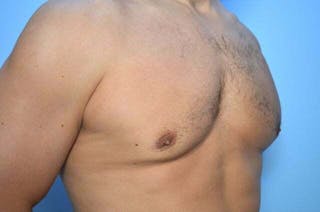 Male Breast Reduction Before & After Gallery - Patient 147447 - Image 4