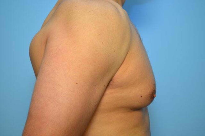 Male Procedures by Dr. Hess Before & After Gallery - Patient 147447 - Image 5