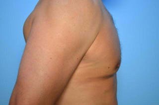 Male Breast Reduction Before & After Gallery - Patient 147447 - Image 6