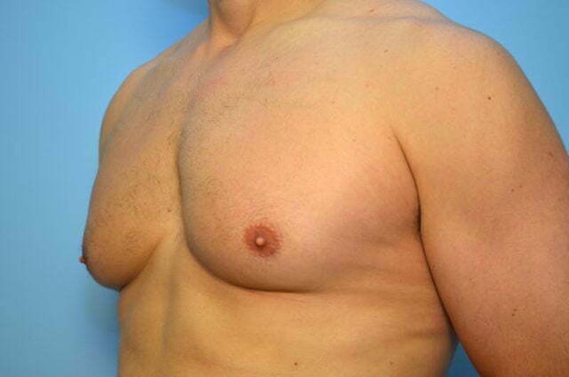 Male Procedures by Dr. Hess Before & After Gallery - Patient 147447 - Image 7