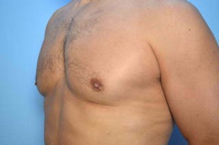 Male Breast Reduction Before & After Gallery - Patient 147447 - Image 8