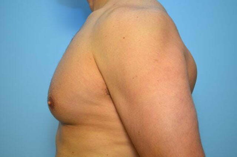 Male Procedures by Dr. Hess Before & After Gallery - Patient 147447 - Image 9