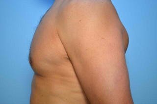 Male Breast Reduction Before & After Gallery - Patient 147447 - Image 10