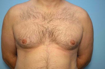 Male Procedures by Dr. Hess Before & After Gallery - Patient 101888 - Image 1