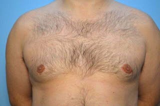 Male Breast Reduction Before & After Gallery - Patient 101888 - Image 2