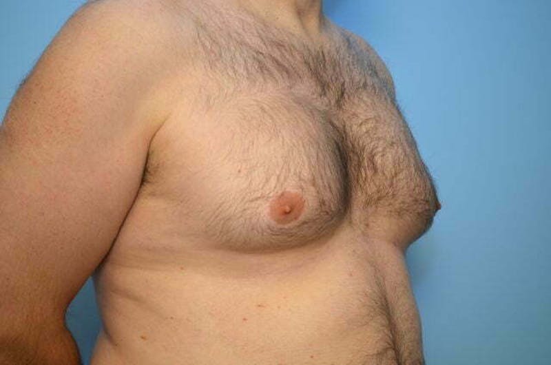 Male Procedures by Dr. Hess Before & After Gallery - Patient 101888 - Image 3