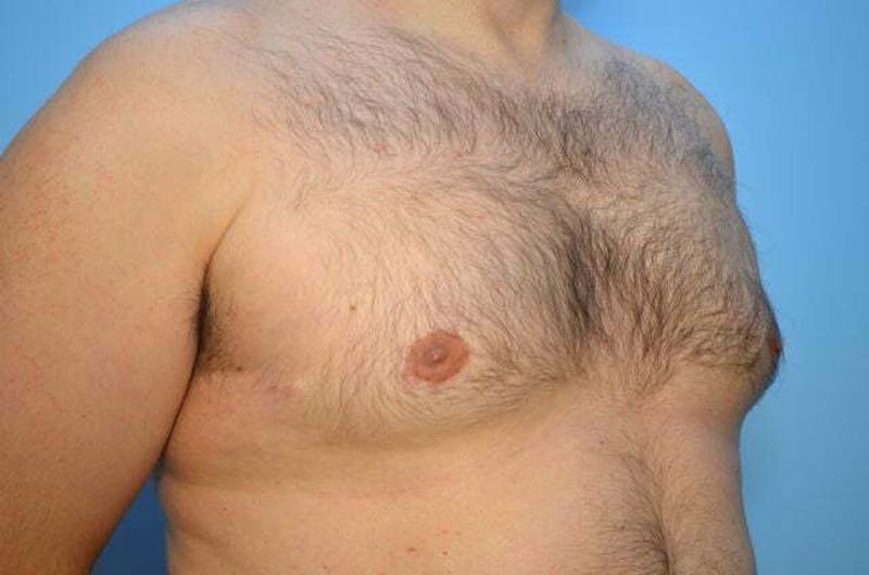 Male Procedures by Dr. Hess Before & After Gallery - Patient 101888 - Image 4