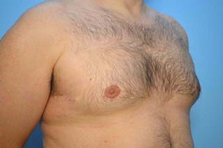 Male Breast Reduction Before & After Gallery - Patient 101888 - Image 4