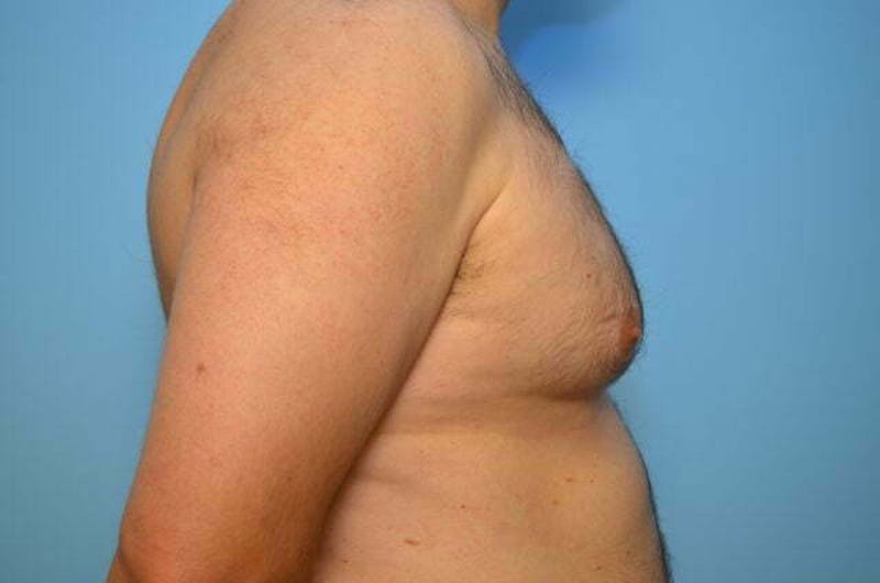 Male Procedures by Dr. Hess Before & After Gallery - Patient 101888 - Image 5