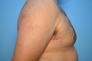 Male Breast Reduction Before & After Gallery - Patient 101888 - Image 6