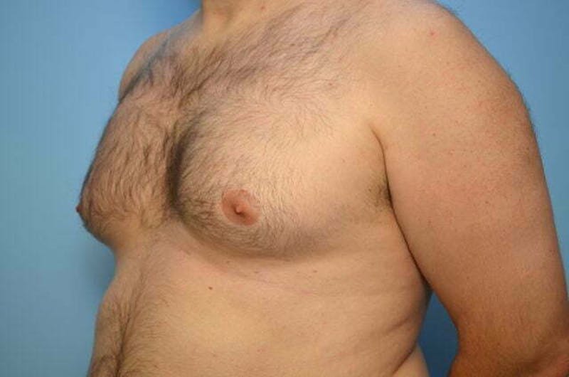 Male Procedures by Dr. Hess Before & After Gallery - Patient 101888 - Image 7