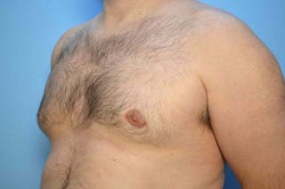 Male Breast Reduction Before & After Gallery - Patient 101888 - Image 8