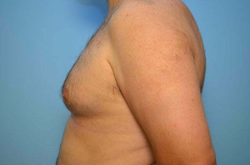Male Procedures by Dr. Hess Before & After Gallery - Patient 101888 - Image 9