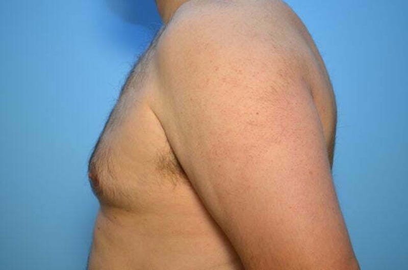 Male Procedures by Dr. Hess Before & After Gallery - Patient 101888 - Image 10
