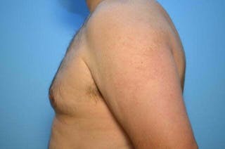 Male Breast Reduction Before & After Gallery - Patient 101888 - Image 10
