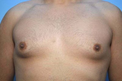 Male Procedures by Dr. Hess Before & After Gallery - Patient 396104 - Image 1