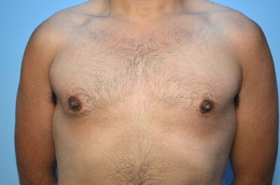 Male Procedures by Dr. Hess Before & After Gallery - Patient 396104 - Image 2