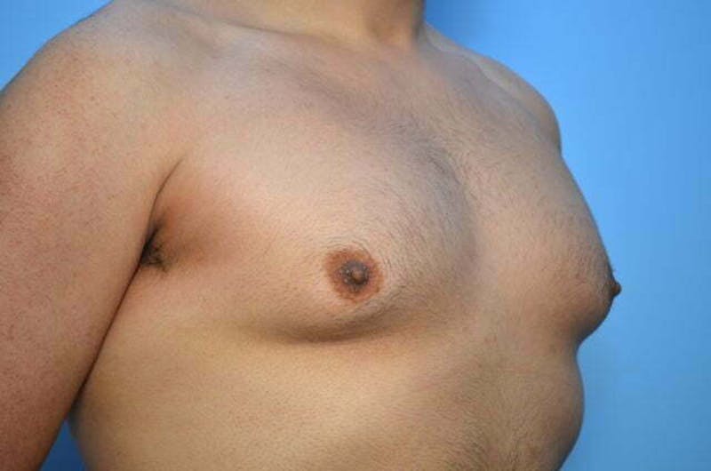 Male Procedures by Dr. Hess Before & After Gallery - Patient 396104 - Image 3