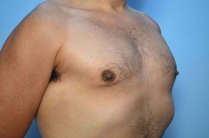 Male Procedures by Dr. Hess Before & After Gallery - Patient 396104 - Image 4