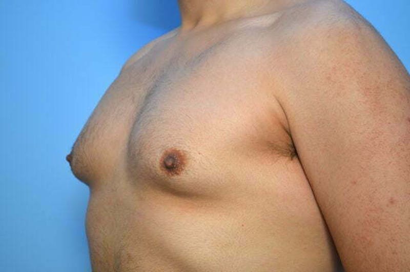 Male Procedures by Dr. Hess Before & After Gallery - Patient 396104 - Image 7