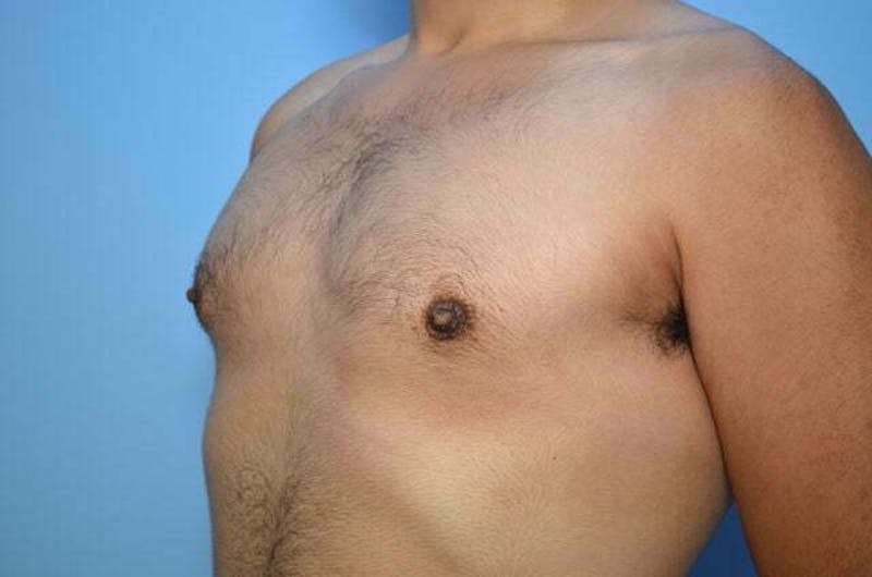 Male Procedures by Dr. Hess Before & After Gallery - Patient 396104 - Image 8