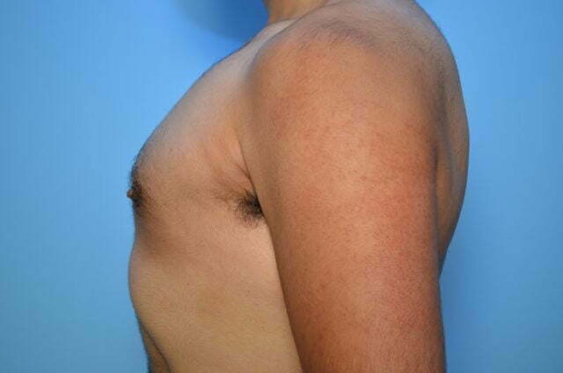 Male Procedures by Dr. Hess Before & After Gallery - Patient 396104 - Image 9