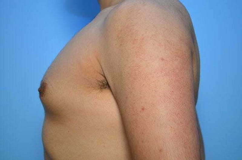 Male Procedures by Dr. Hess Before & After Gallery - Patient 396104 - Image 10