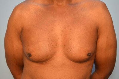 Male Procedures by Dr. Hess Before & After Gallery - Patient 366149 - Image 1