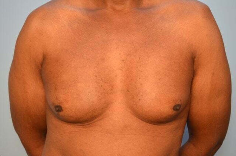 Male Procedures by Dr. Hess Before & After Gallery - Patient 366149 - Image 1