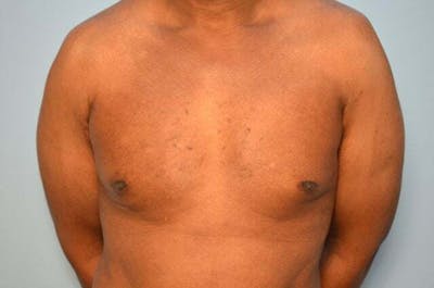 Male Procedures by Dr. Hess Before & After Gallery - Patient 366149 - Image 2
