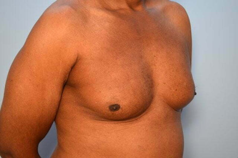 Male Procedures by Dr. Hess Before & After Gallery - Patient 366149 - Image 3