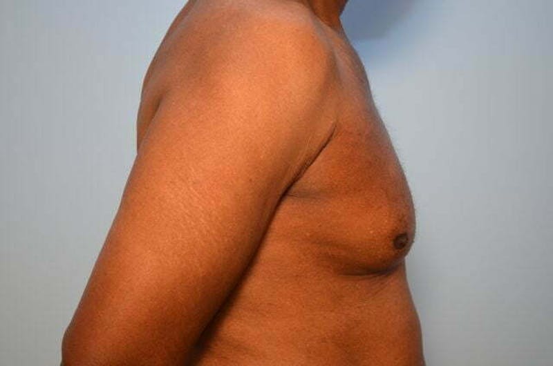 Male Procedures by Dr. Hess Before & After Gallery - Patient 366149 - Image 5
