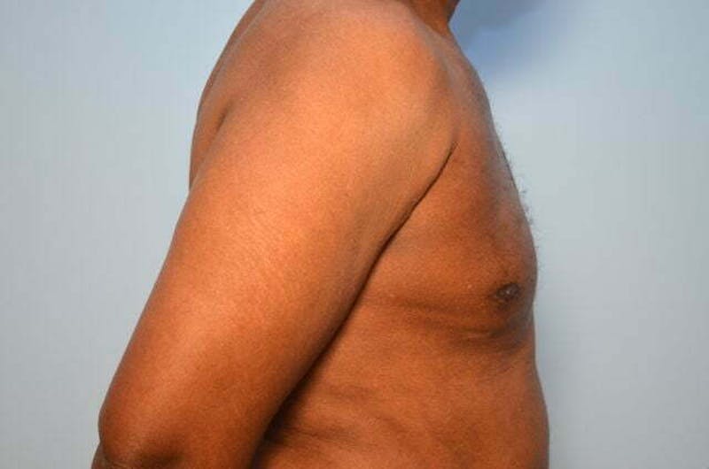 Male Procedures by Dr. Hess Before & After Gallery - Patient 366149 - Image 6