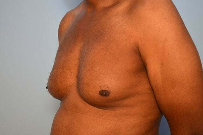 Male Procedures by Dr. Hess Before & After Gallery - Patient 366149 - Image 7