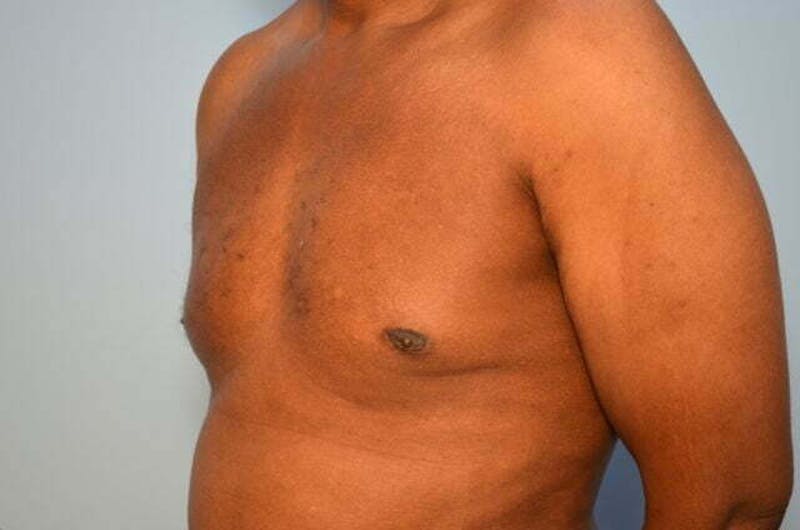 Male Procedures by Dr. Hess Before & After Gallery - Patient 366149 - Image 8