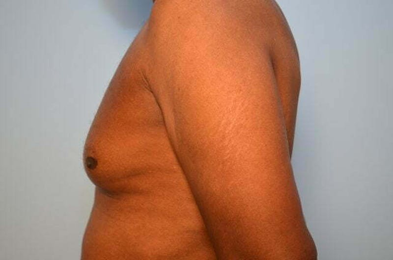 Male Procedures by Dr. Hess Before & After Gallery - Patient 366149 - Image 9