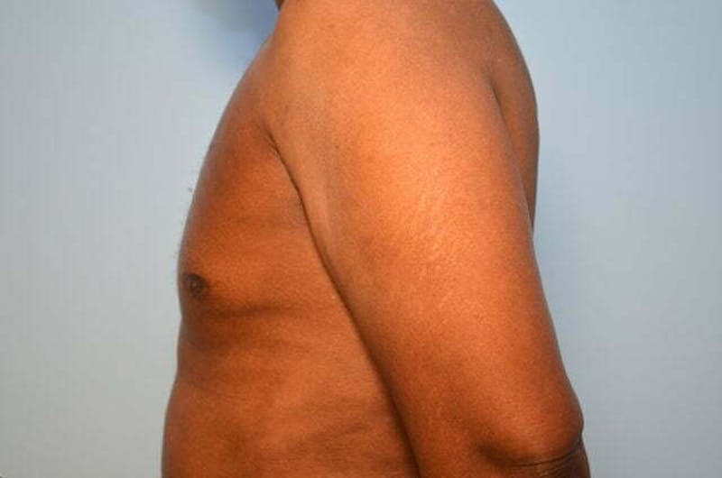 Male Procedures by Dr. Hess Before & After Gallery - Patient 366149 - Image 10