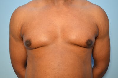 Male Procedures by Dr. Hess Before & After Gallery - Patient 329970 - Image 1