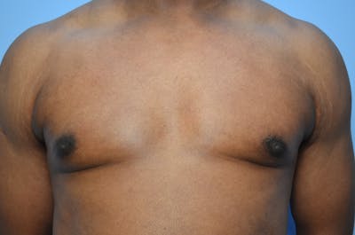 Male Procedures by Dr. Hess Before & After Gallery - Patient 329970 - Image 2
