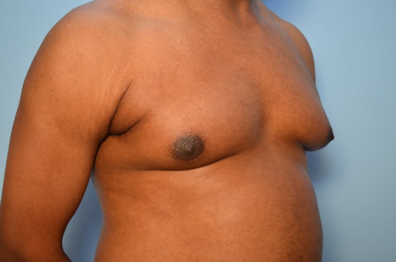 Male Procedures by Dr. Hess Before & After Gallery - Patient 329970 - Image 3
