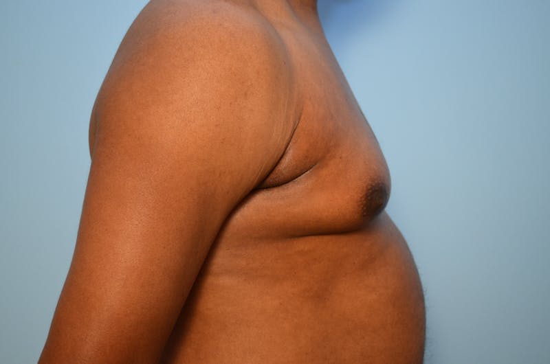 Male Procedures by Dr. Hess Before & After Gallery - Patient 329970 - Image 5