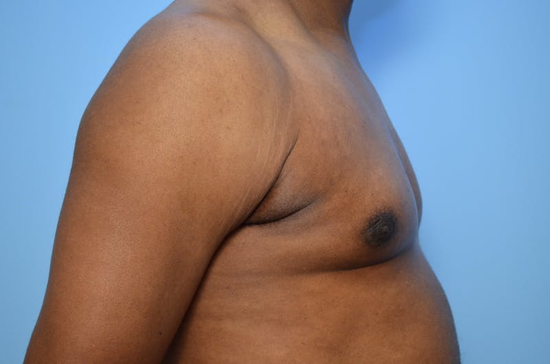 Male Procedures by Dr. Hess Before & After Gallery - Patient 329970 - Image 6