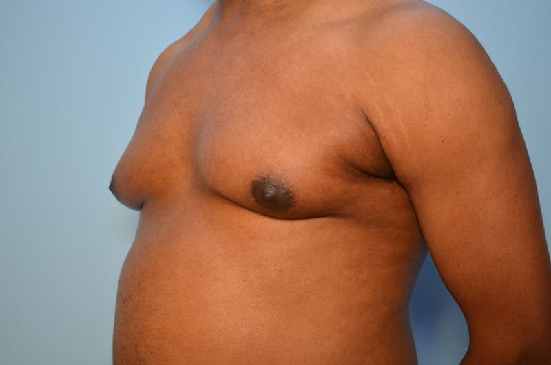 Male Procedures by Dr. Hess Before & After Gallery - Patient 329970 - Image 7